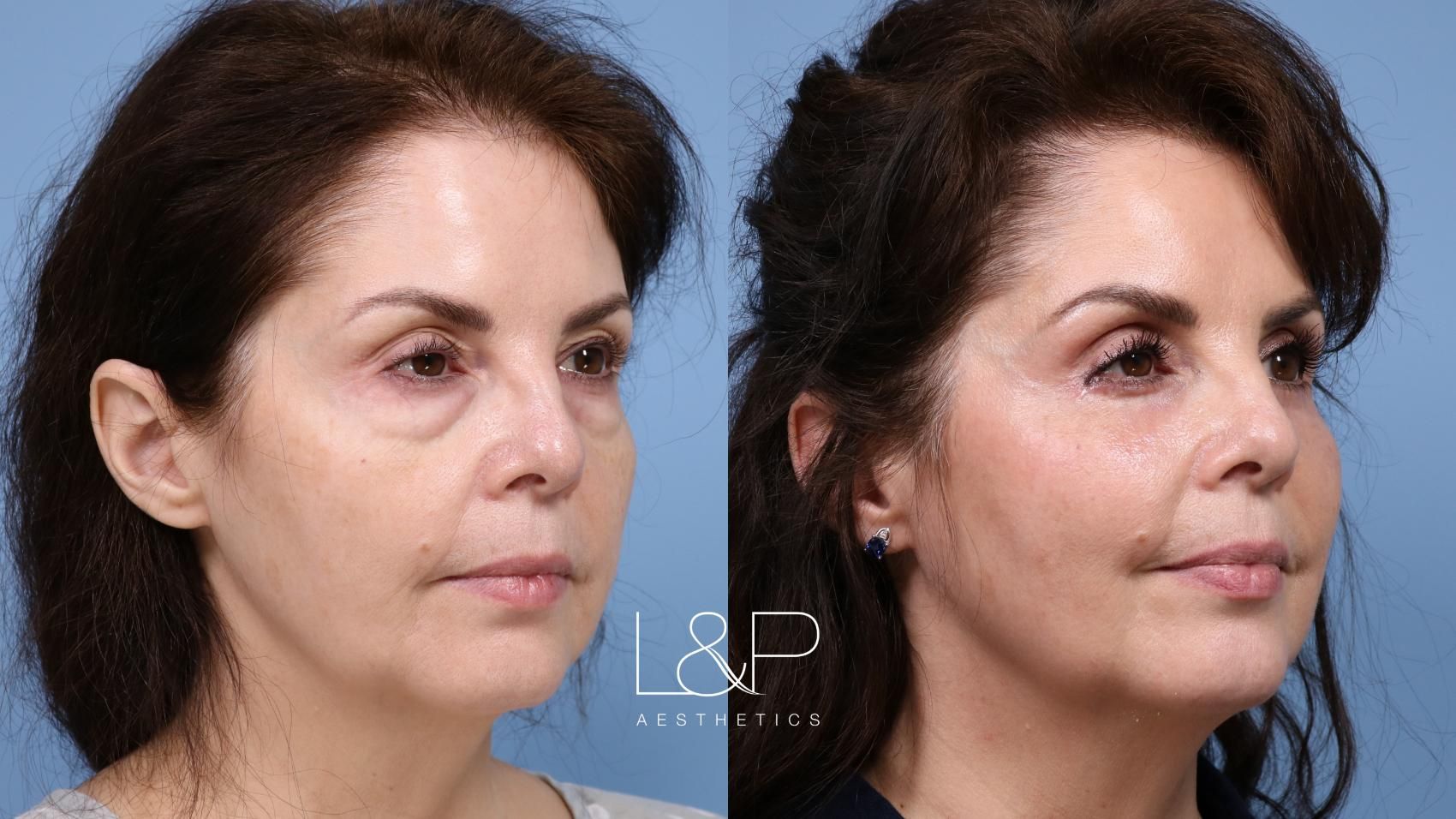 Blepharoplasty before and after treatment