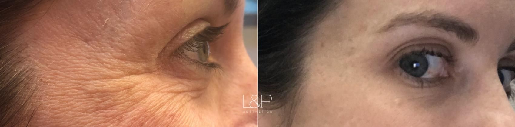 Botox Cosmetic before and after treatment