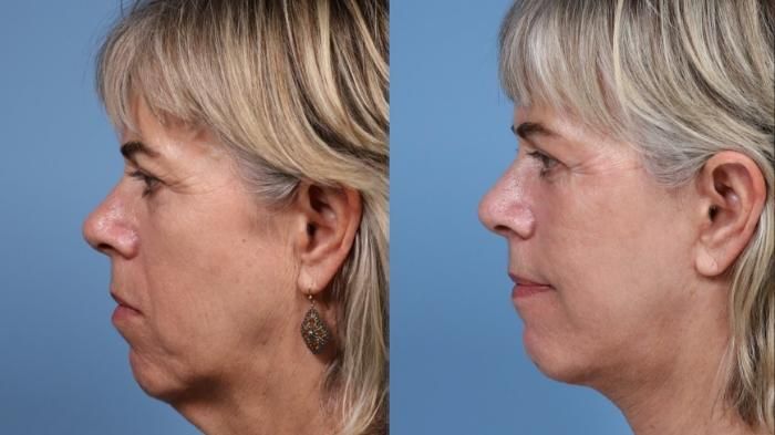 Facelift Neck Lift before and after treatment in CA
