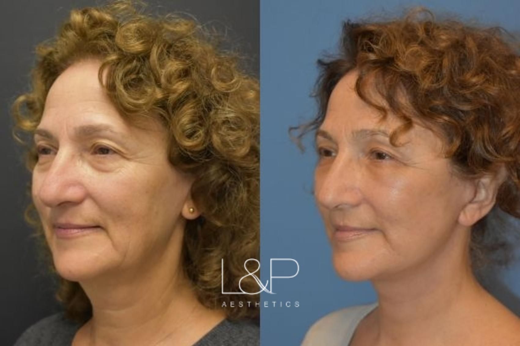 Facelift Neck Lift before and after treatment in Palo Alto, California