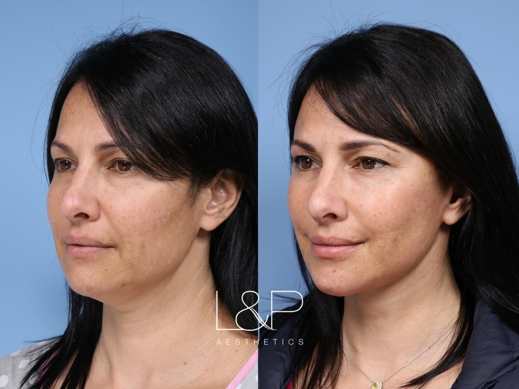 Facelift Neck Lift before and after treatment in CA