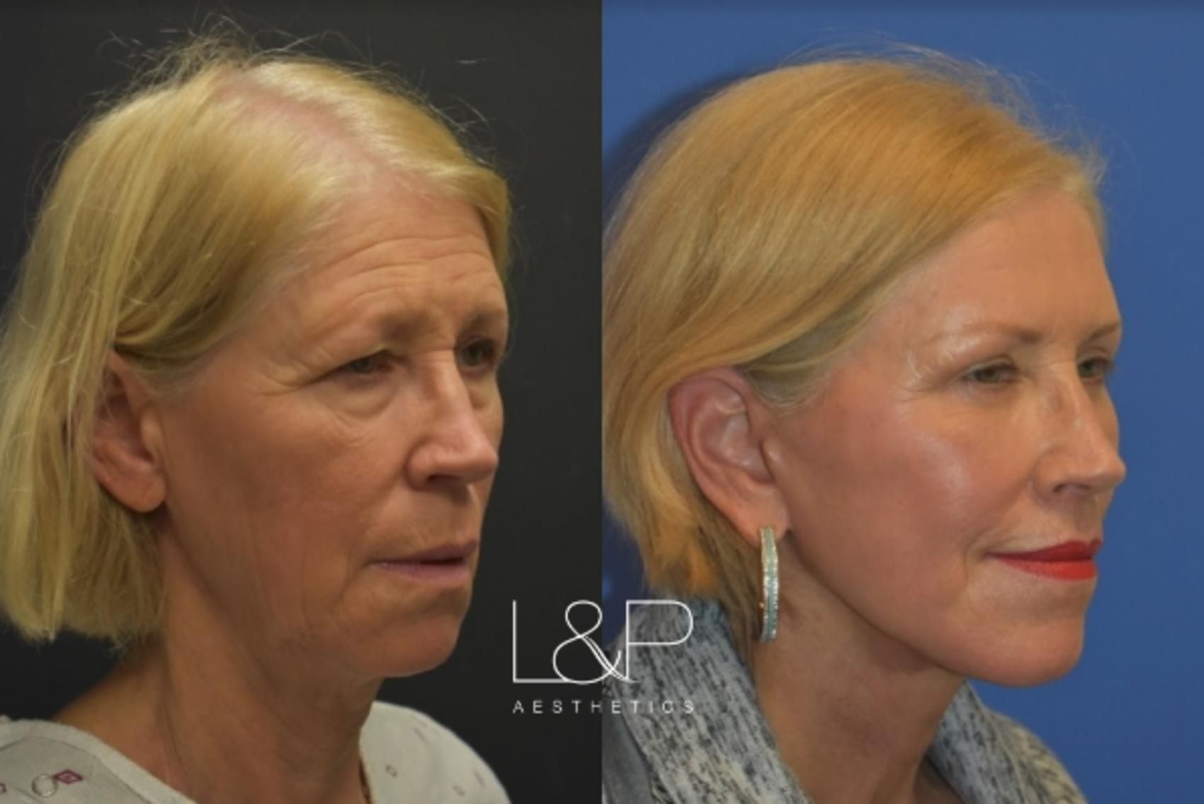 Facelift Neck Lift before and after treatment in Los Gatos, CA