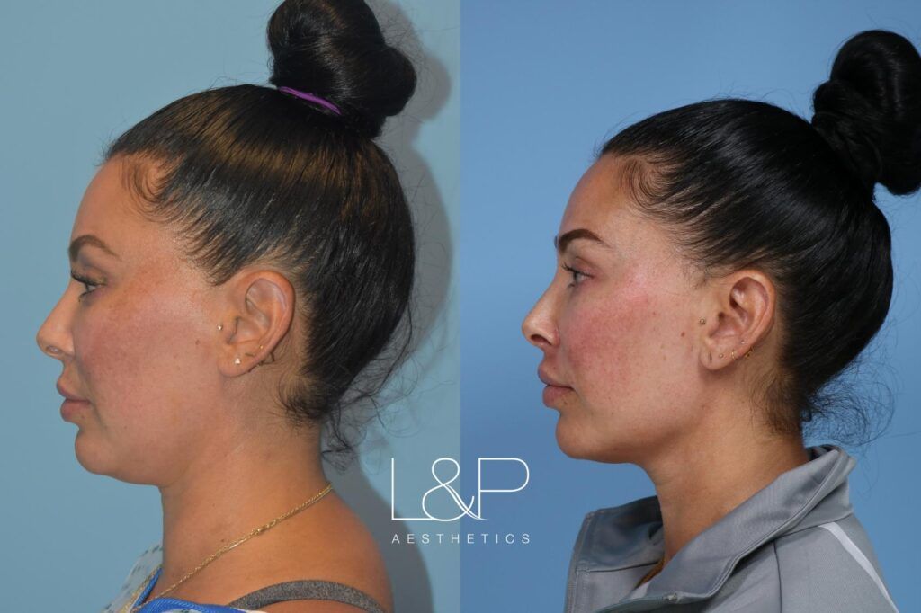 Facetite / Accutite Before and after treatment