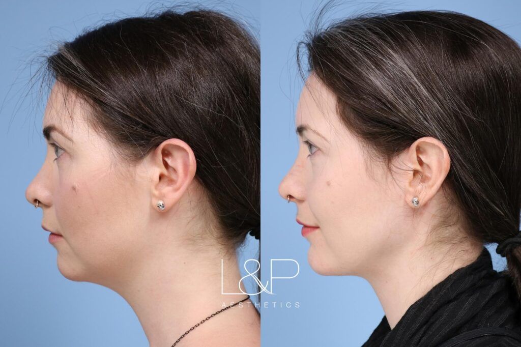 Facetite / Accutite Before and after treatment