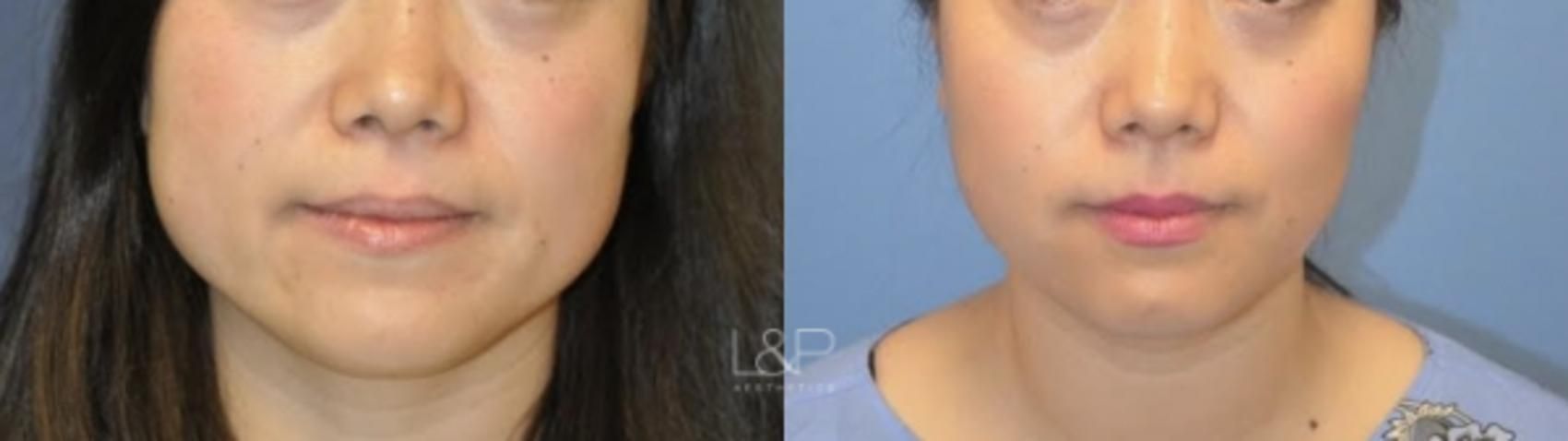Jaw Slimming before and after treatment