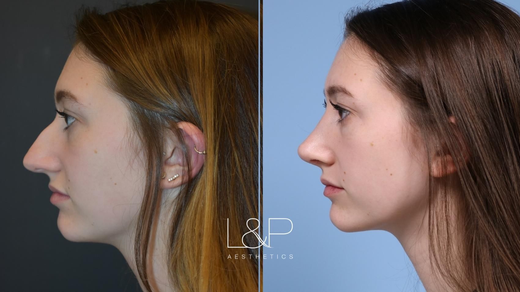 Rhinoplasty before and after treatment in Los Gatos, California