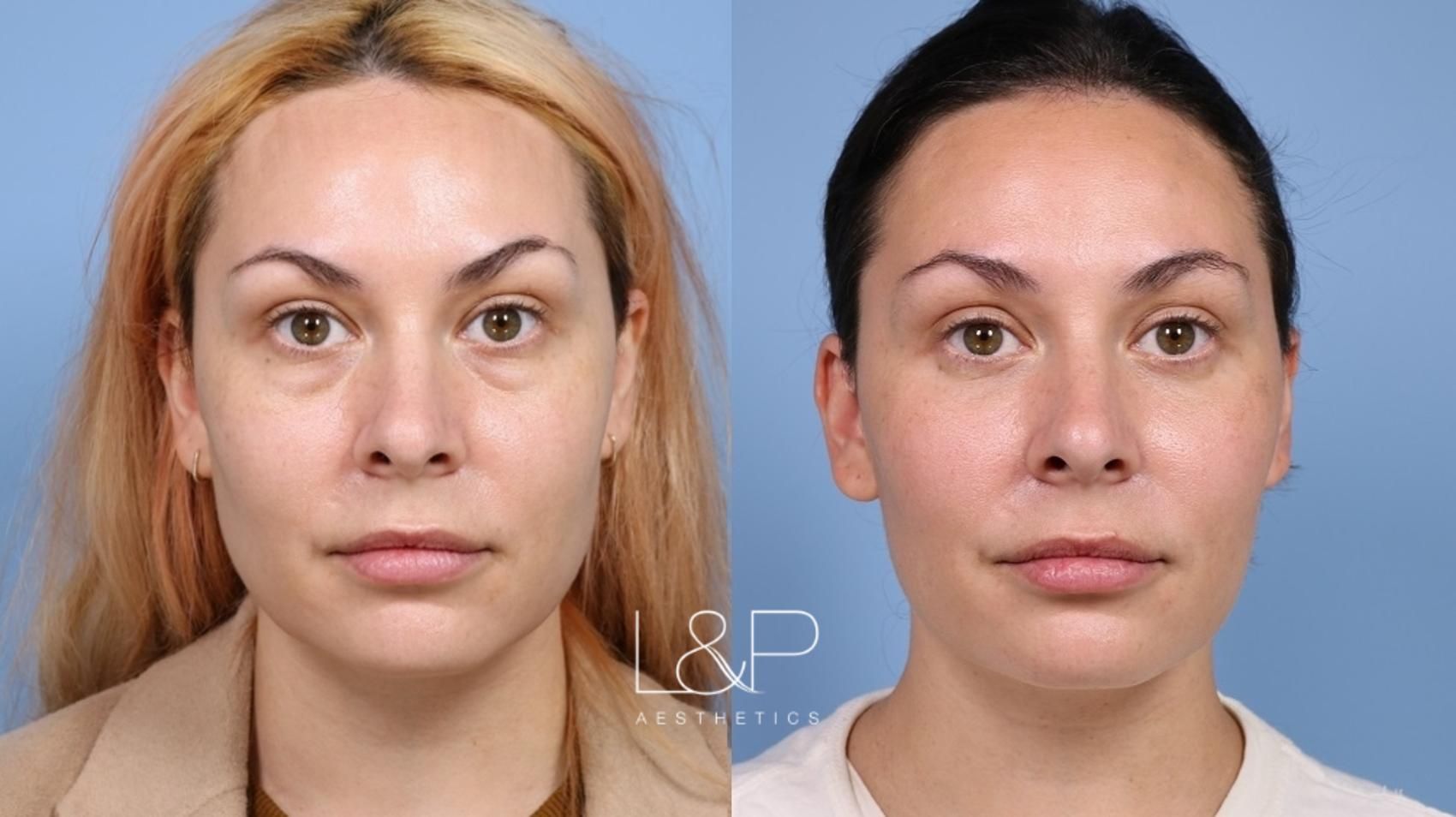 Lower blepharoplasty with limited fat transfer before and after treatment in Palo Alto at L&P Aesthetics