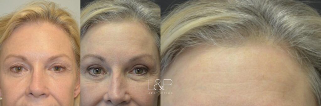 Brow Lift before and after treatment in Los Gatos, California