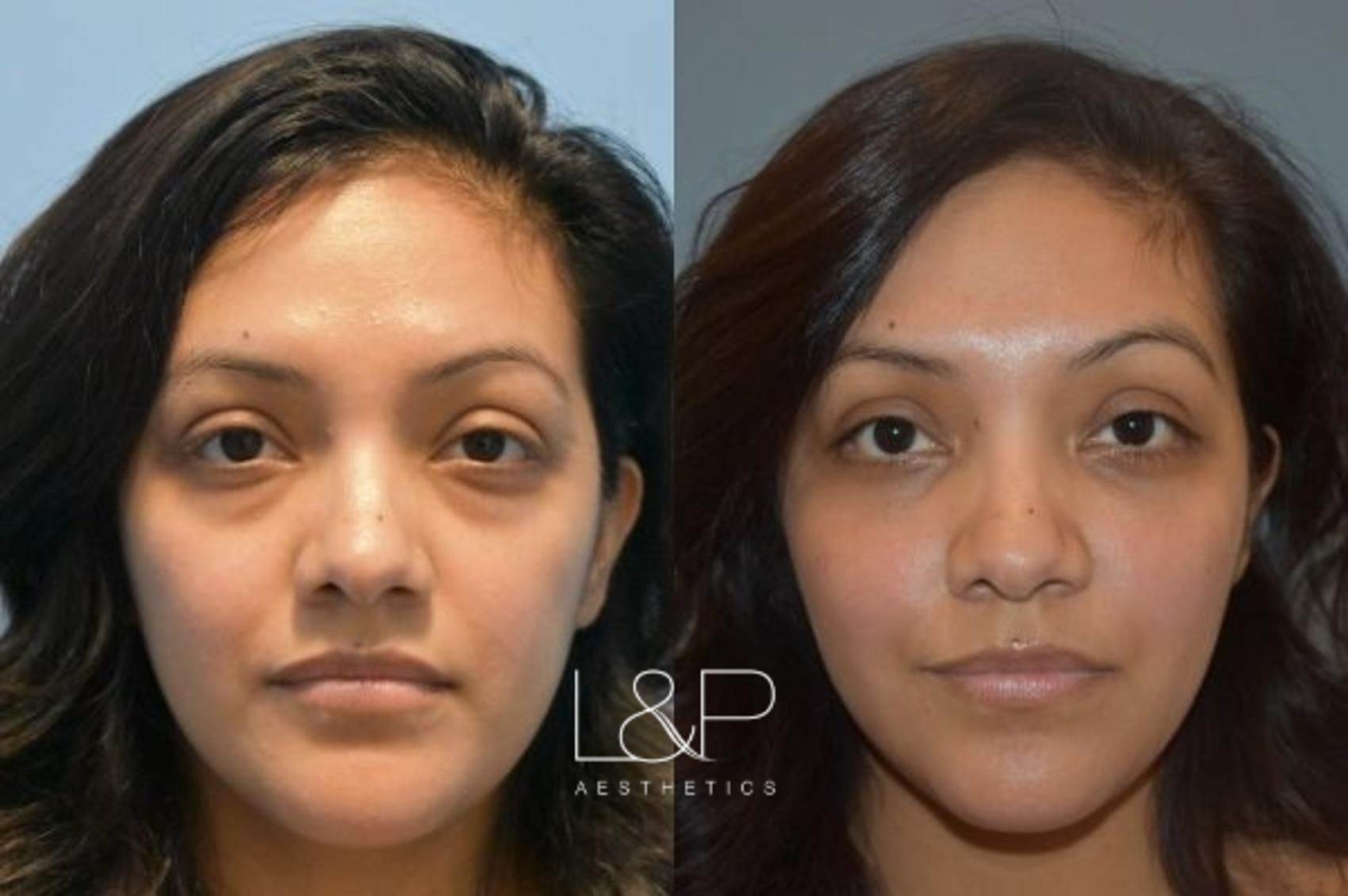 Lower Eyelid Blepharoplasty and Fat Transfer before and after treatment in Palo Alto, California