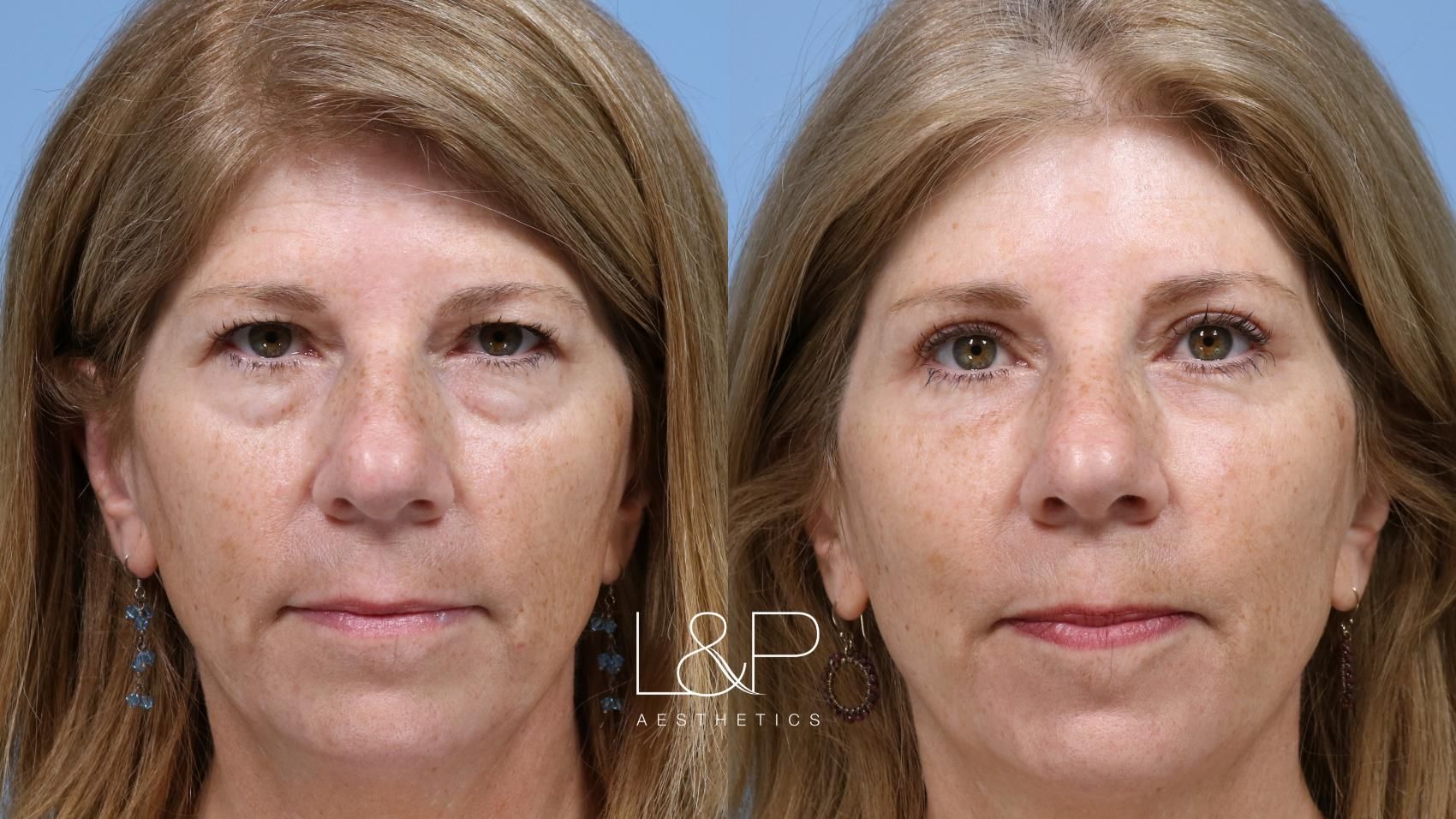 Upper and lower blepharoplasty with brow lift female patient before and after treatment in the Bay Area at L&P Aesthetics