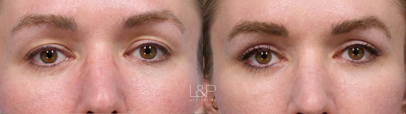 Upper blepharoplasty before and after treatment at L&P Aesthetics in the Bay Area