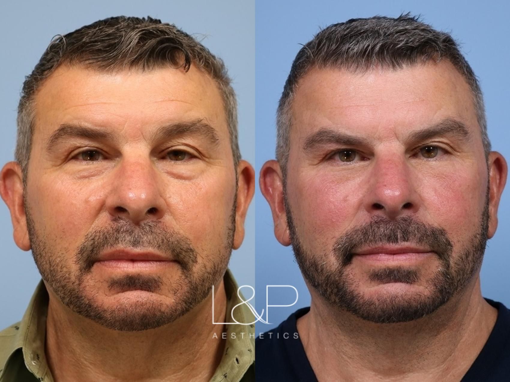 Lower blepharoplasty and fat transfer before and after treatment at L&P Aesthetics in the Bay Area