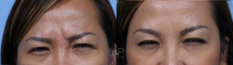 Botox Cosmetic before and after treatment