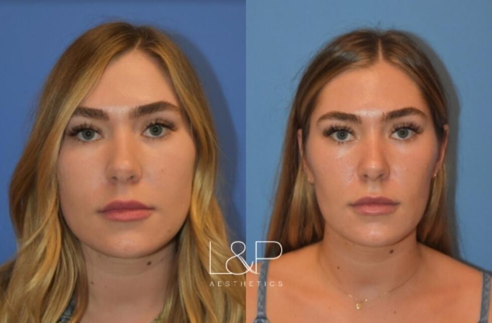 Botox Cosmetic before and after treatment