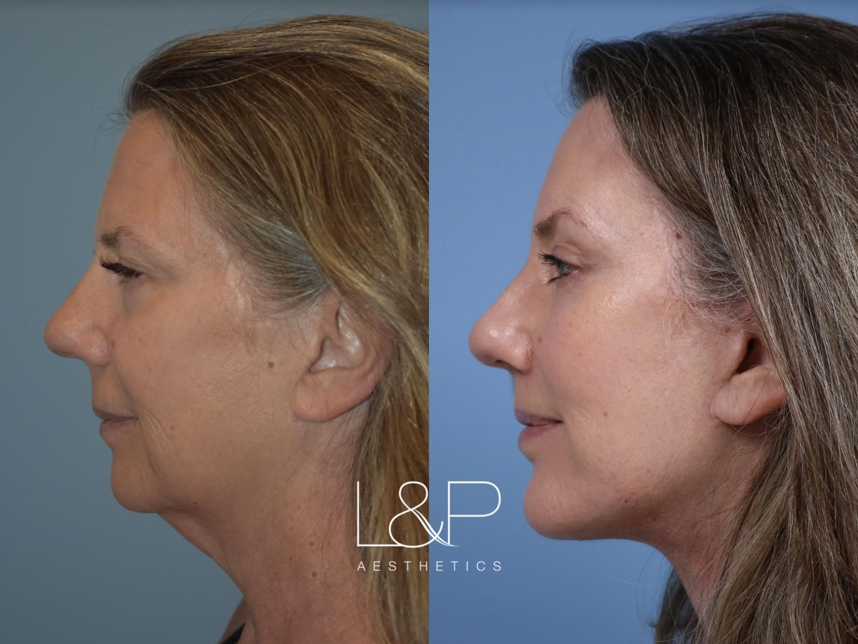 Facelift Neck Lift before and after treatment in the Bay Area
