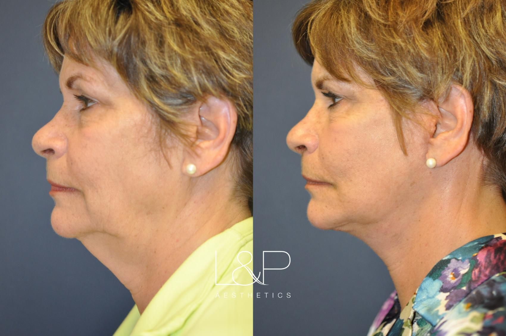 Facelift Neck Lift before and after treatment in Palo Alto, California