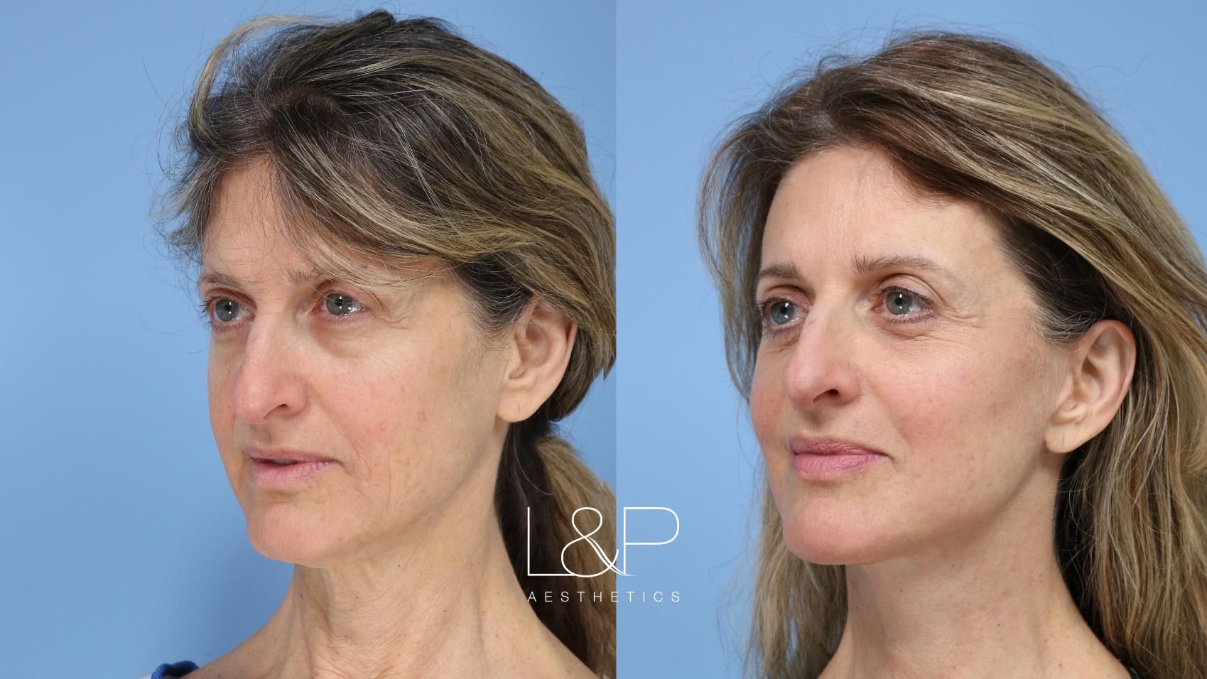 Facelift Neck Lift before and after treatment in the Bay Area