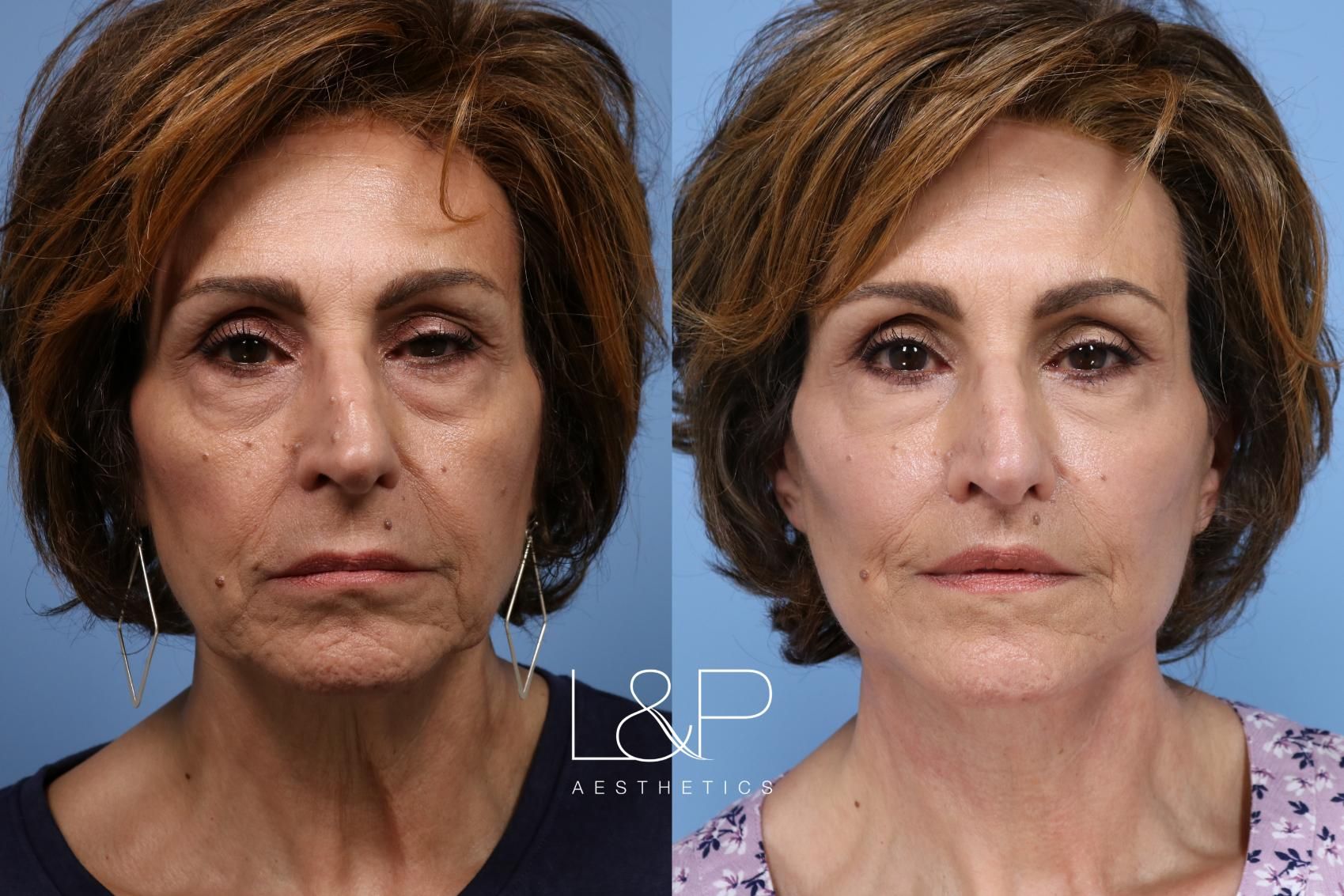 Facelift Neck Lift before and after treatment in Los Gatos, California