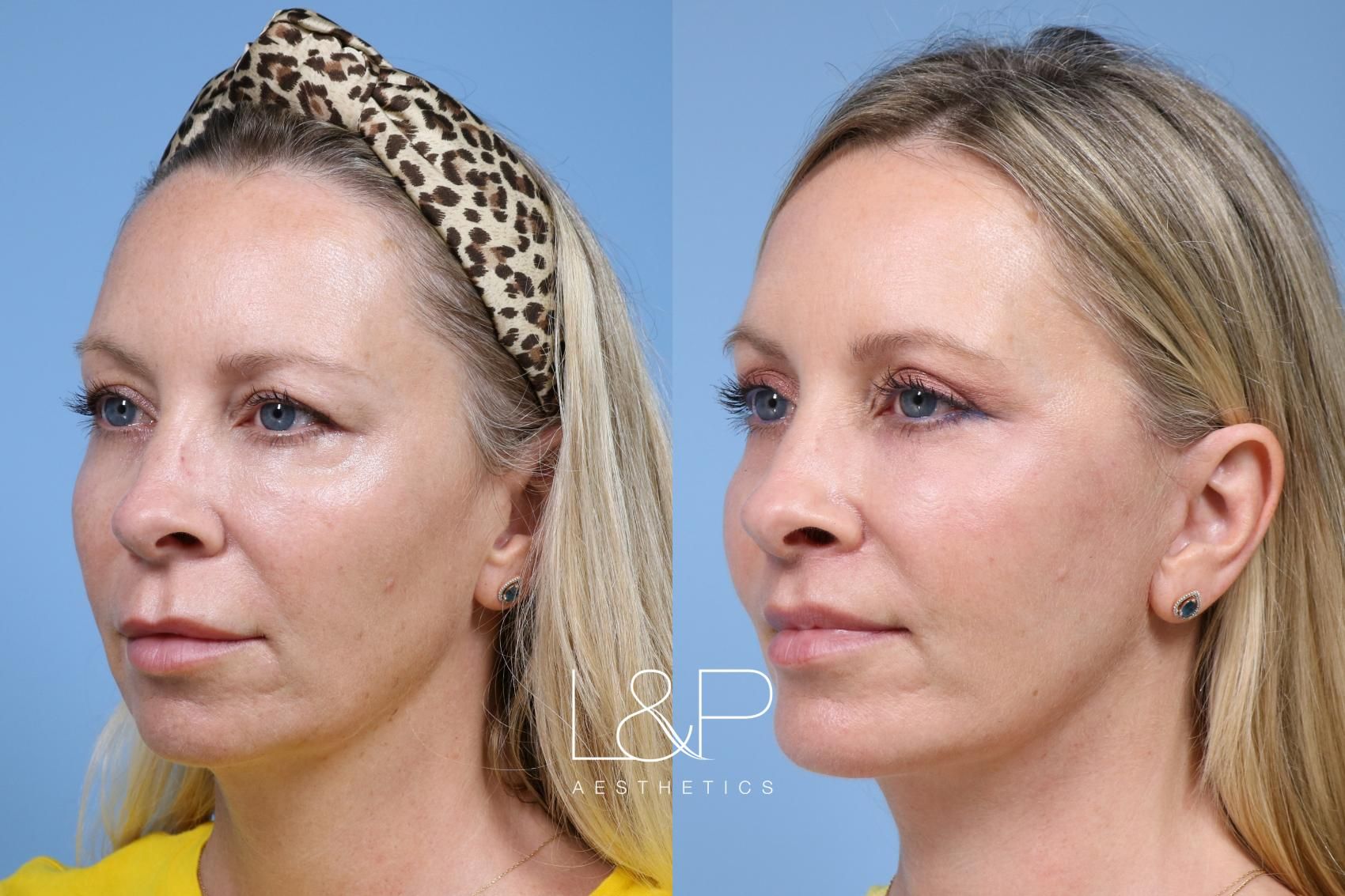 Facelift Neck Lift before and after treatment in Palo Alto, California