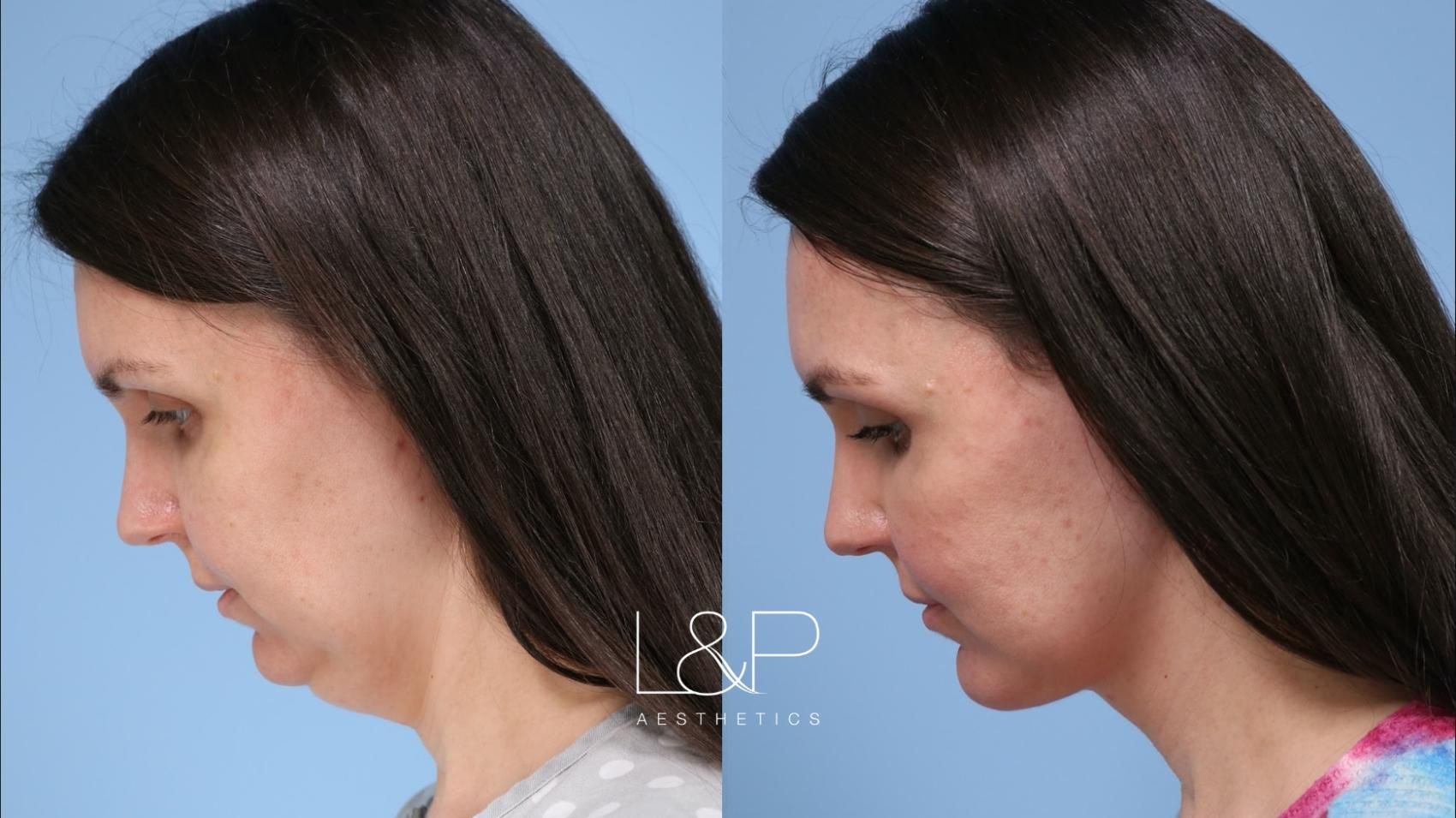 Facelift Neck Lift before and after treatment in California