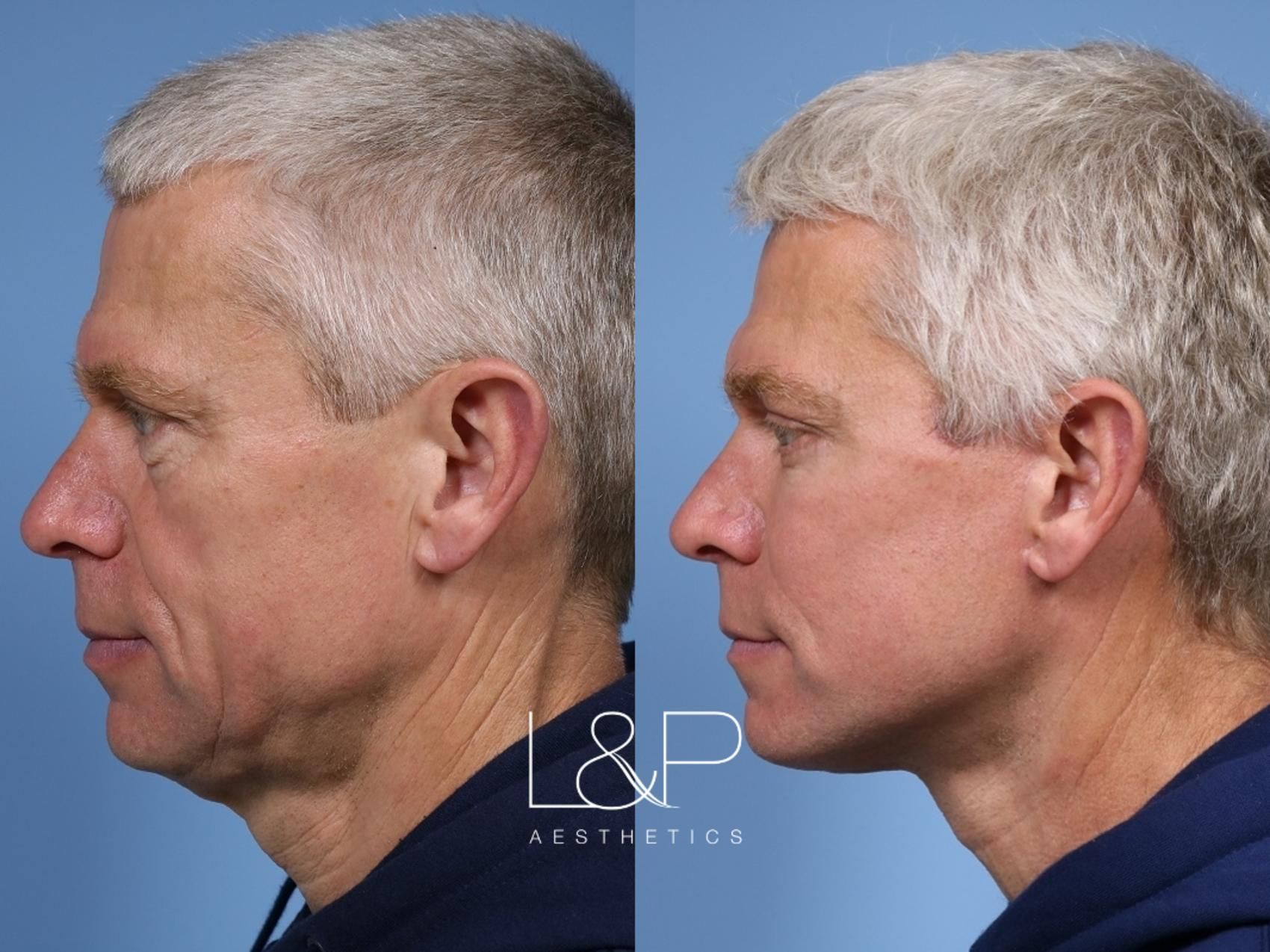 Facelift Neck Lift before and after treatment in Los Gatos, California