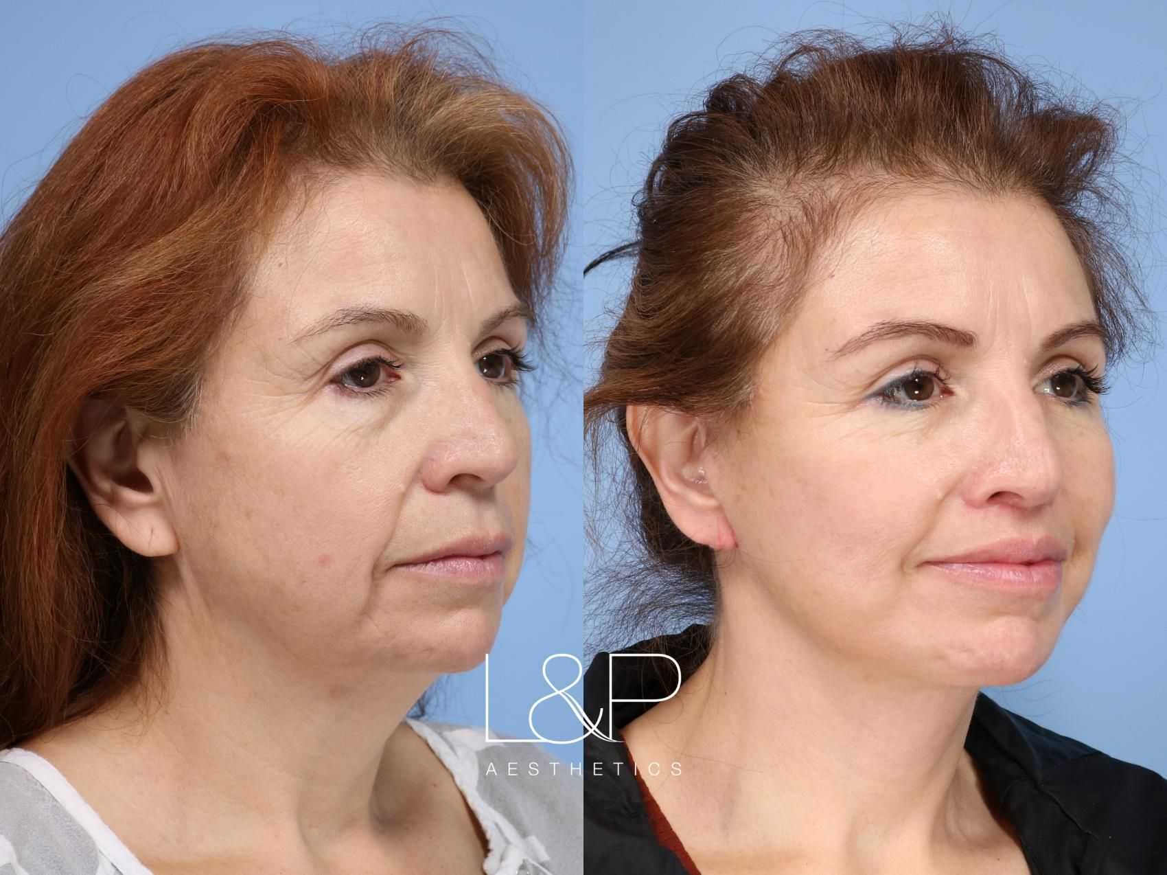 Facelift Neck Lift before and after treatment in Palo Alto, California