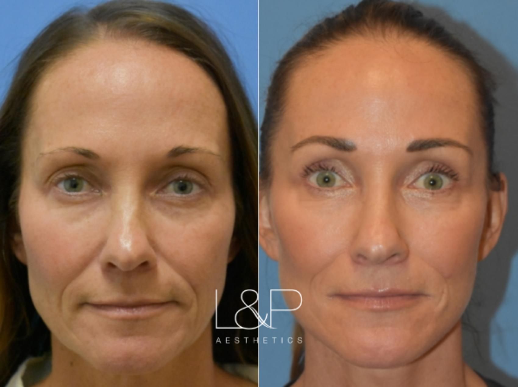 Facelift Neck Lift before and after treatment in Los Gatos, California