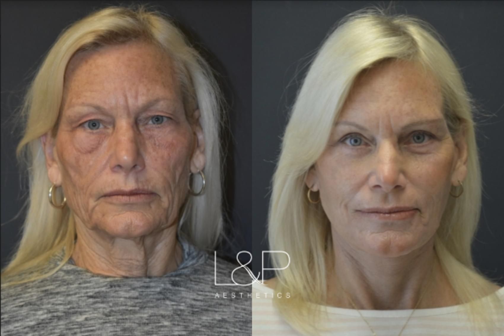 Facelift Neck Lift before and after treatment in the Bay Area