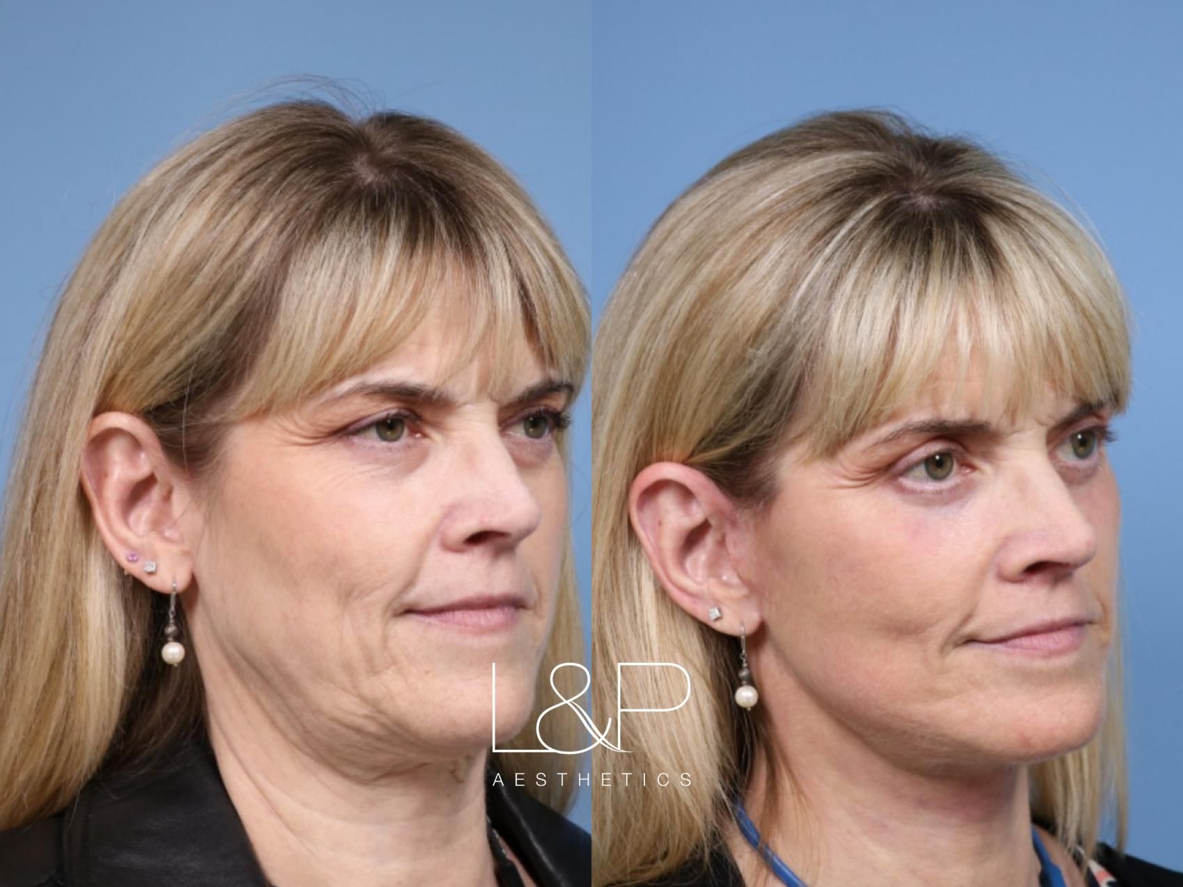 Facelift Neck Lift before and after treatment in Palo Alto, CA