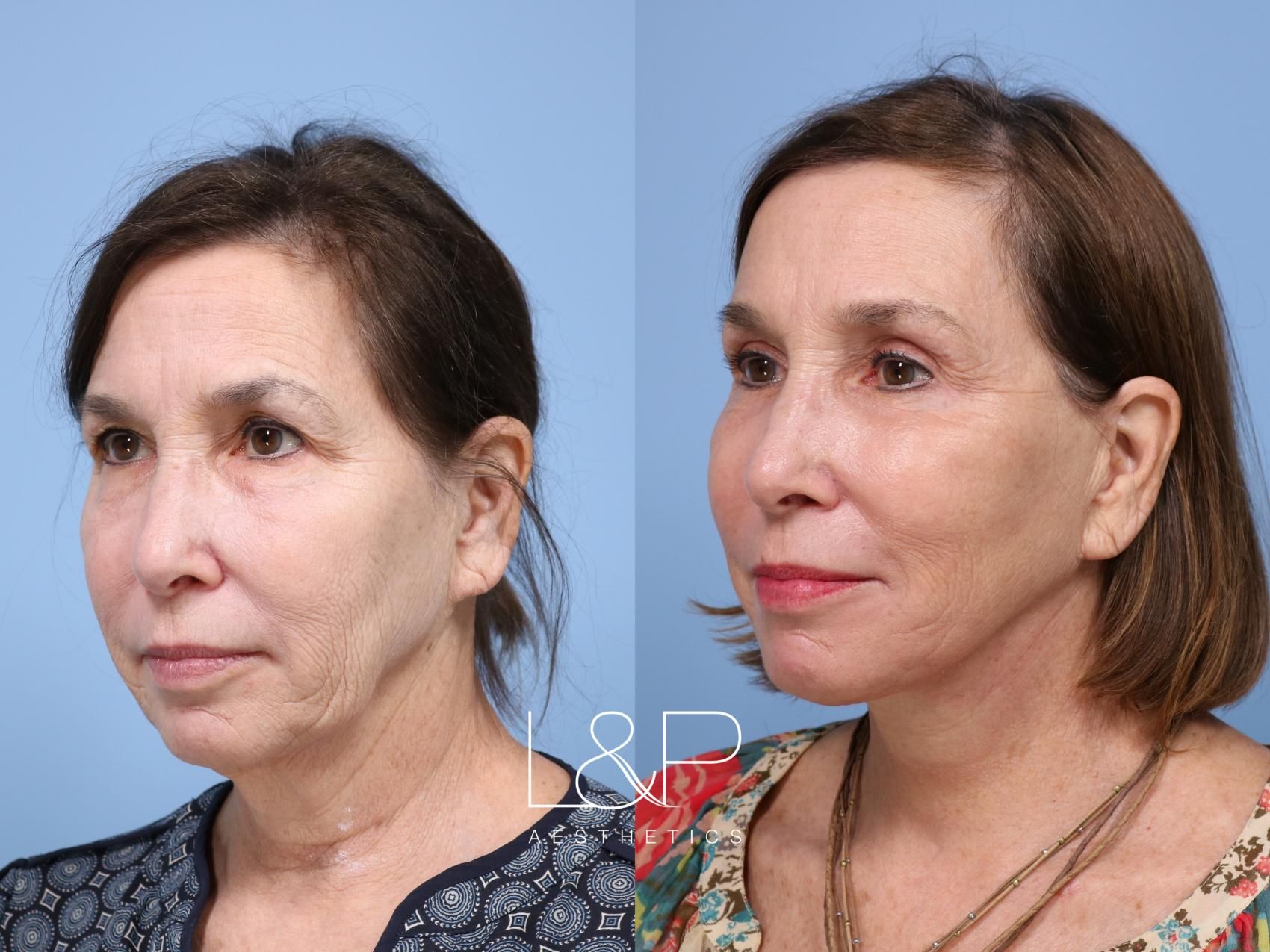 Facelift Neck Lift before and after treatment