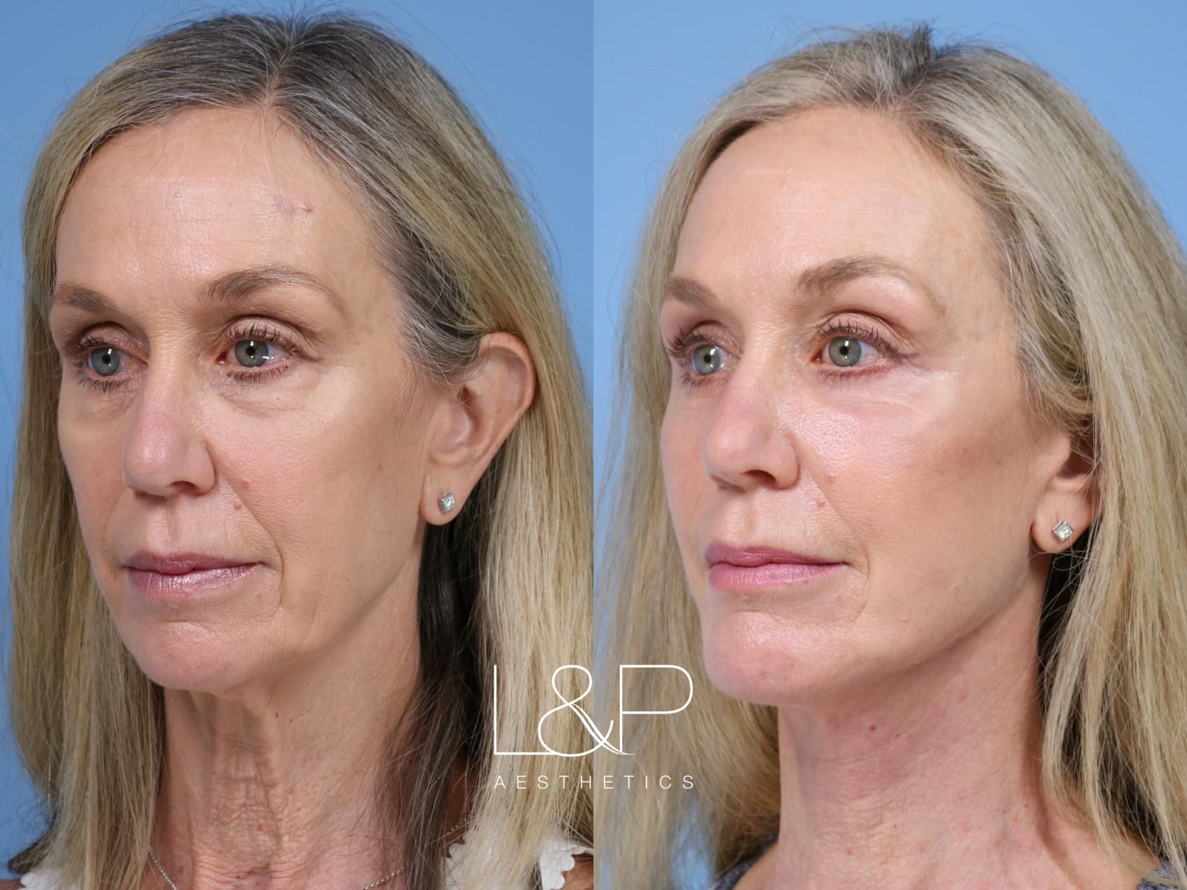 Facelift Neck Lift before and after treatment