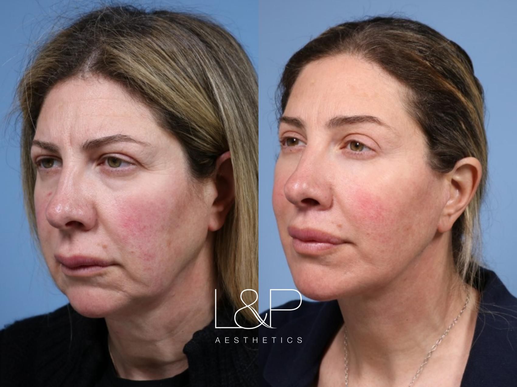 Facelift Neck Lift before and after treatment