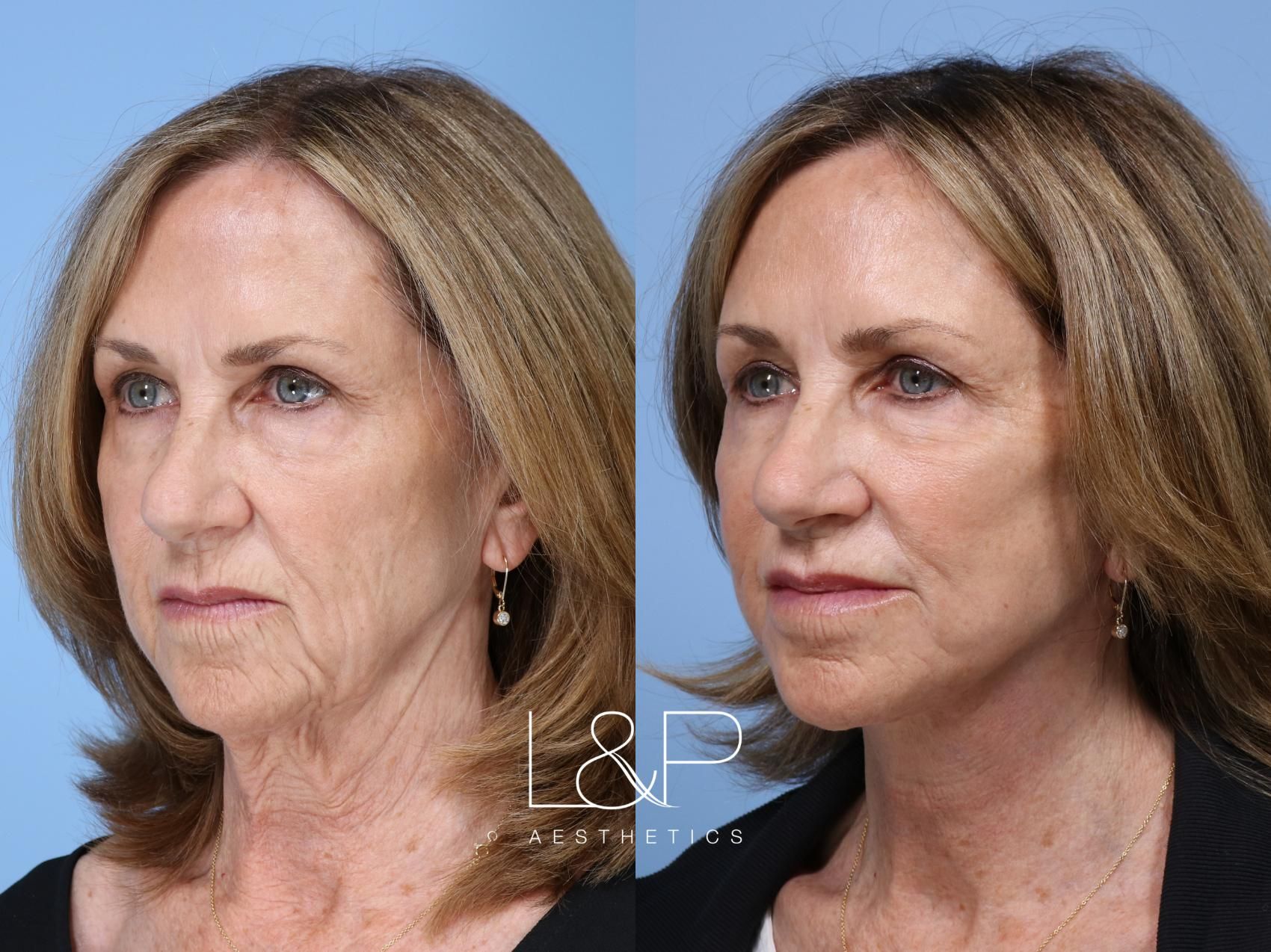 Facelift Neck Lift before and after treatment