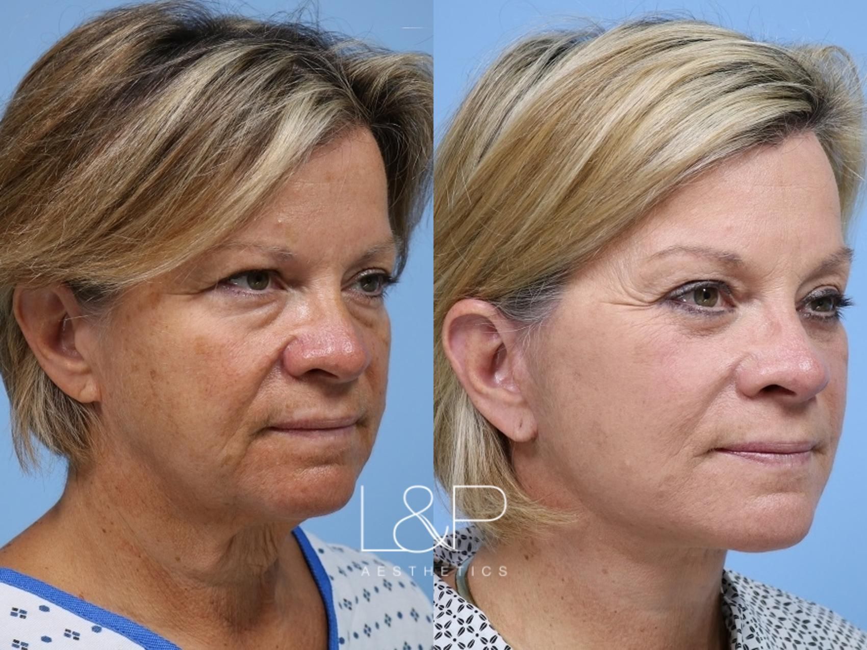 Facelift Neck Lift before and after treatment