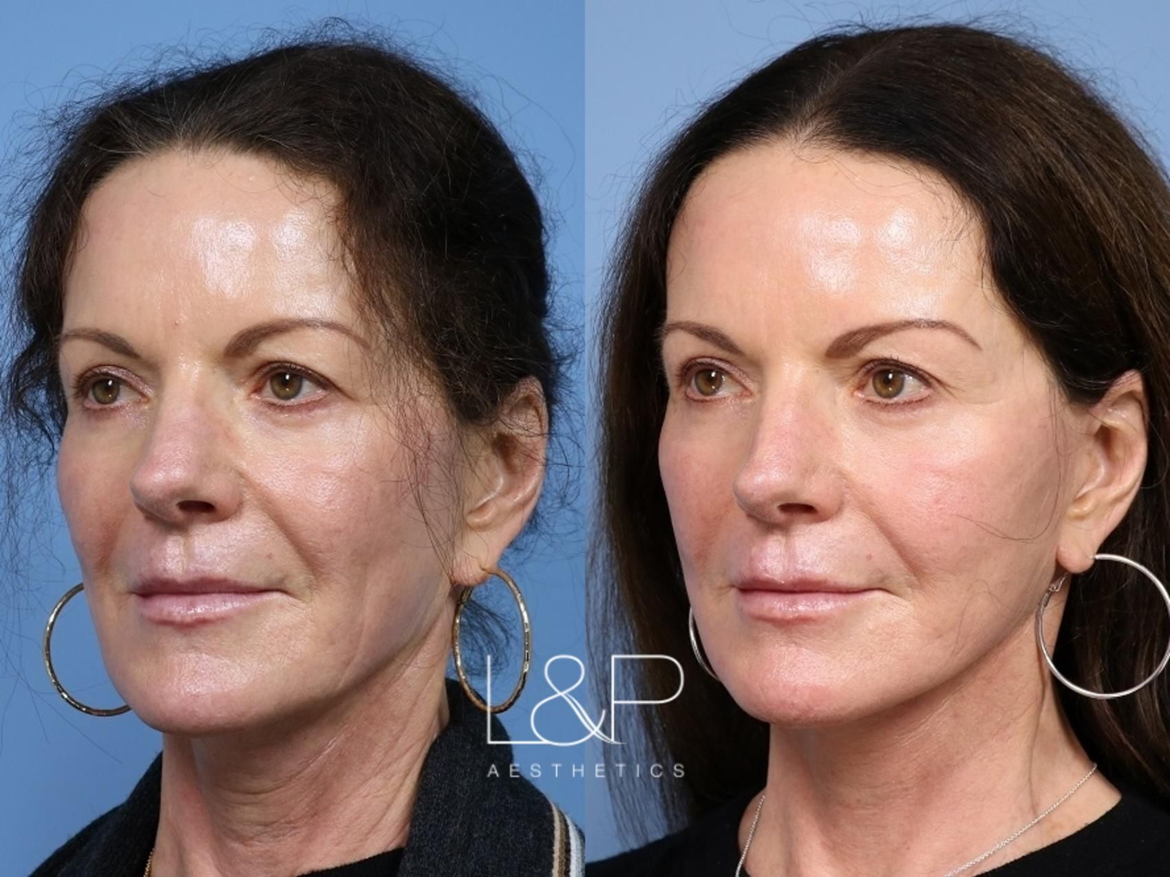 Facelift Neck Lift before and after treatment - Facelift Palo Alto