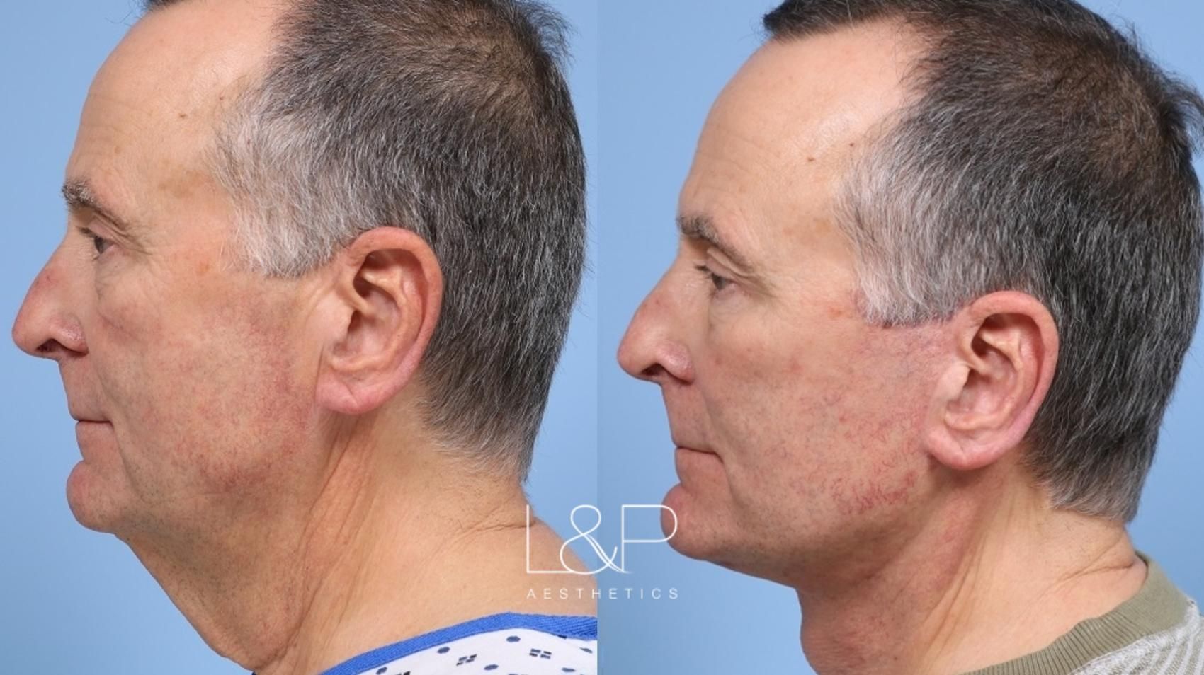Facelift Neck Lift before and after treatment