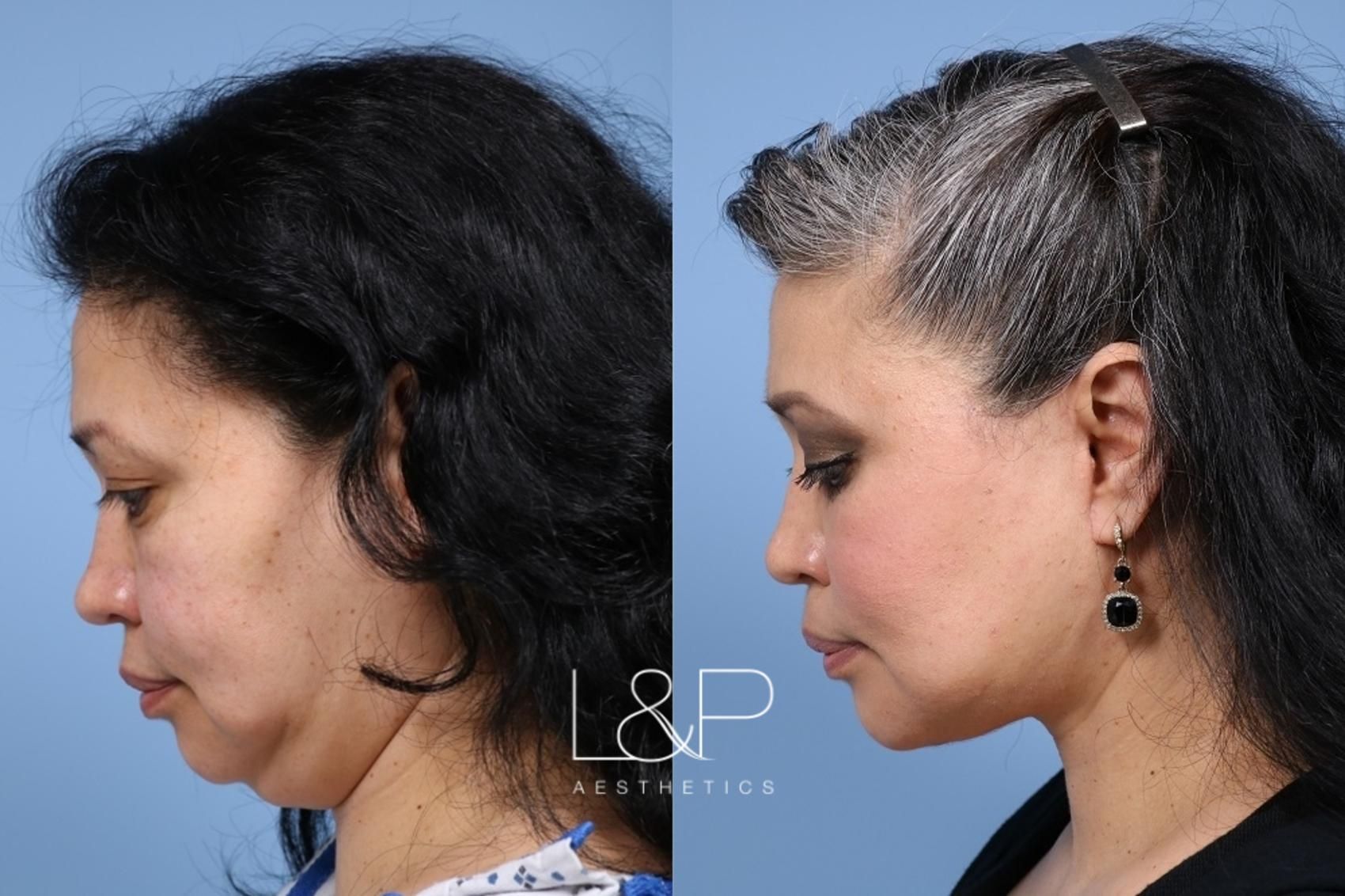 Facelift Neck Lift before and after treatment in Palo Alto, California