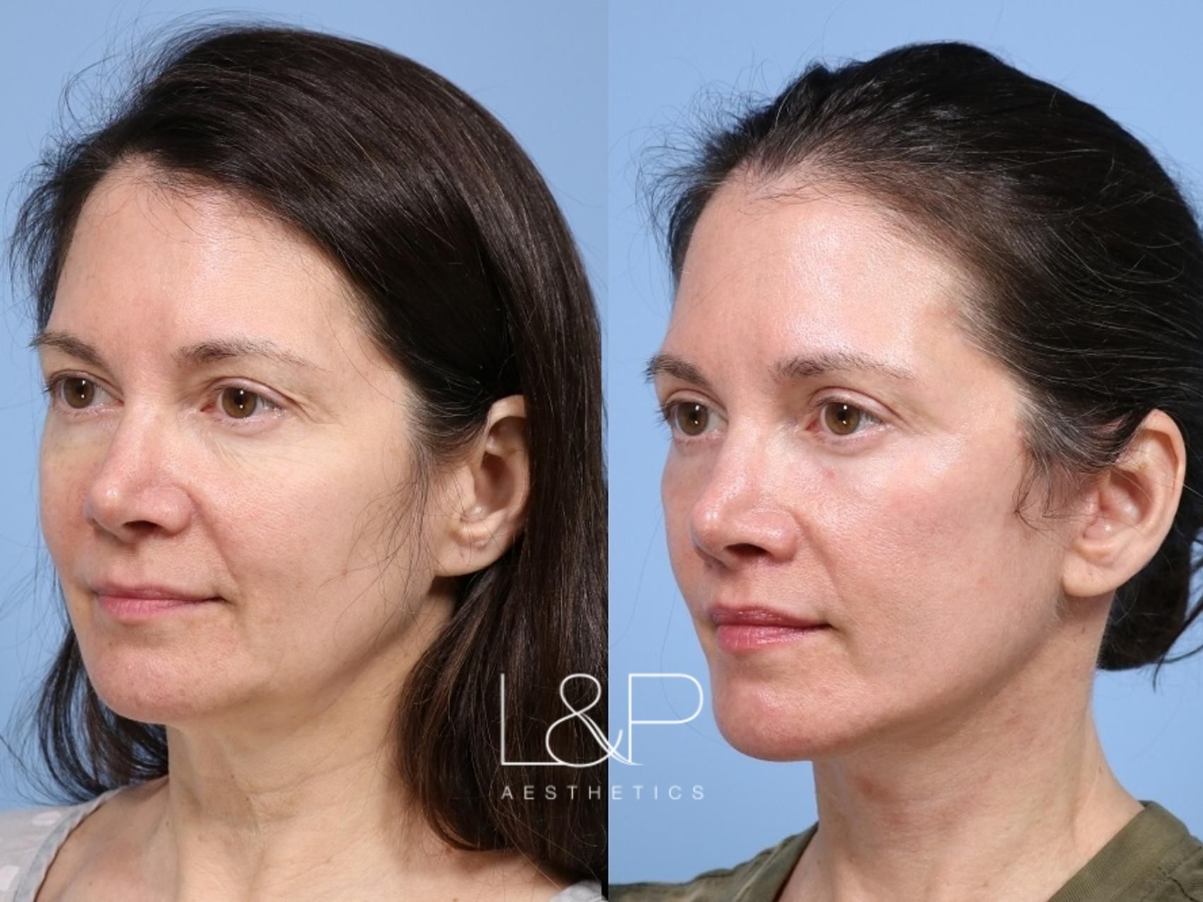 Facelift Neck Lift before and after treatment