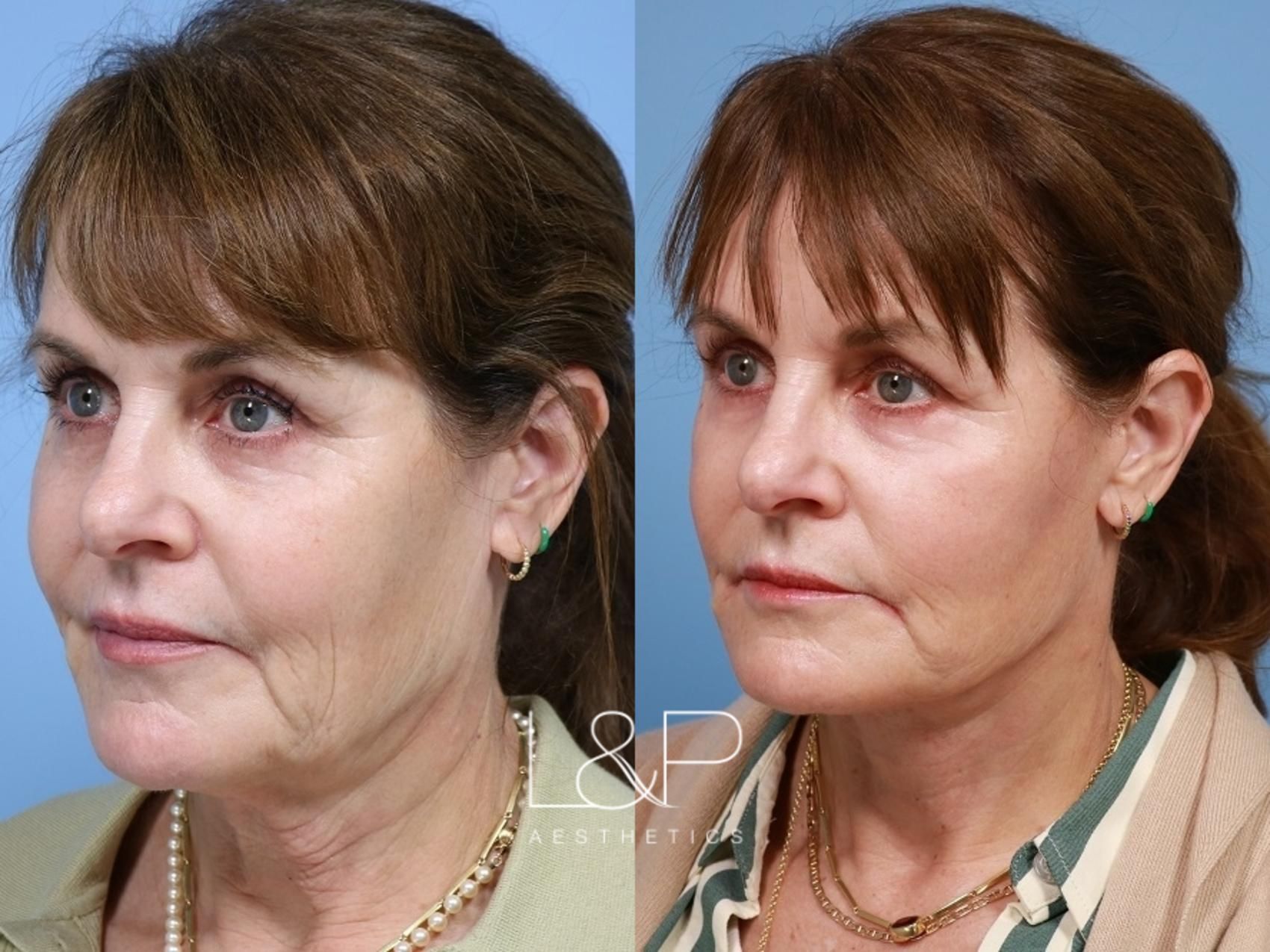 Facelift Neck Lift before and after treatment