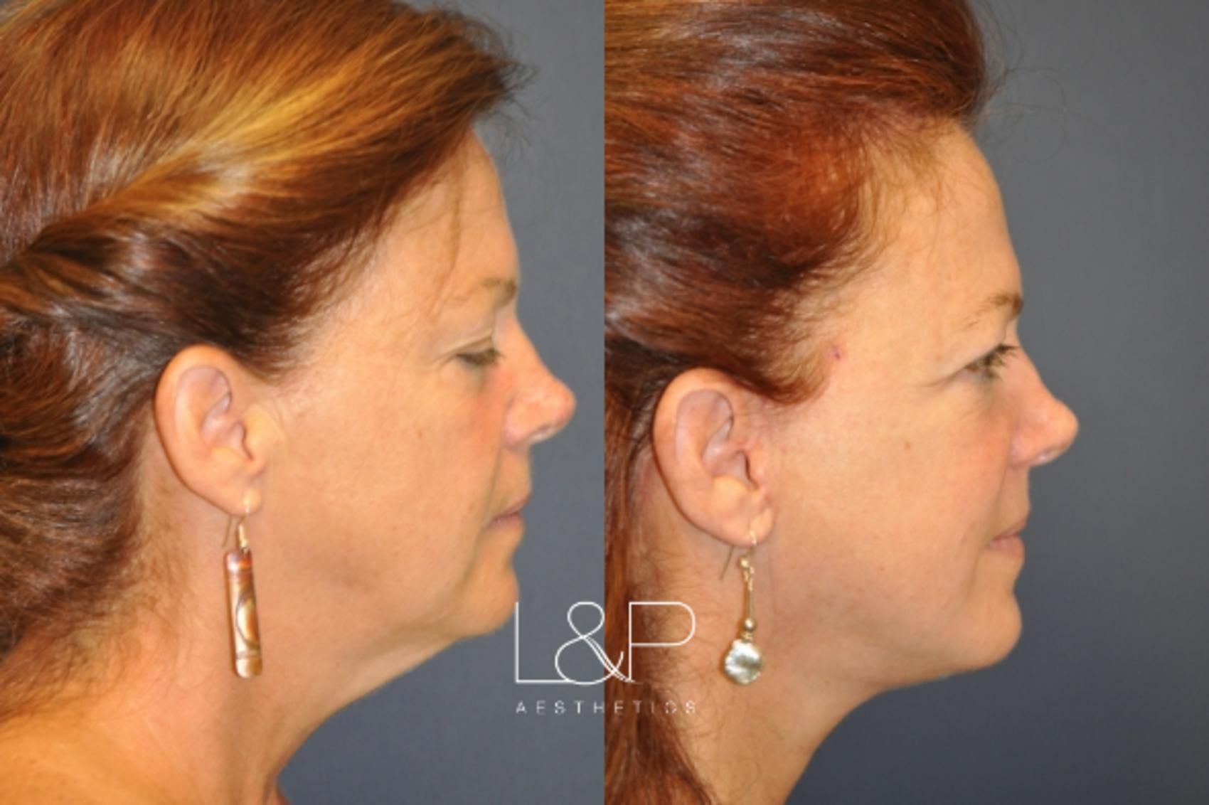 Facelift Neck Lift before and after treatment in California