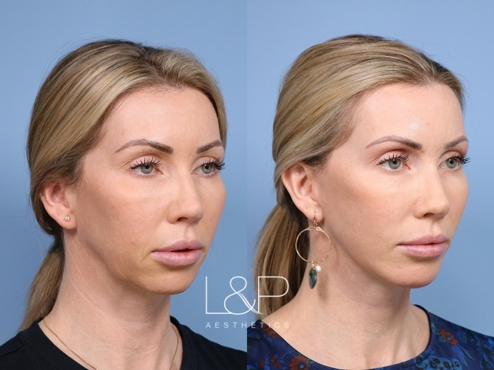 Facelift Neck Lift before and after treatment