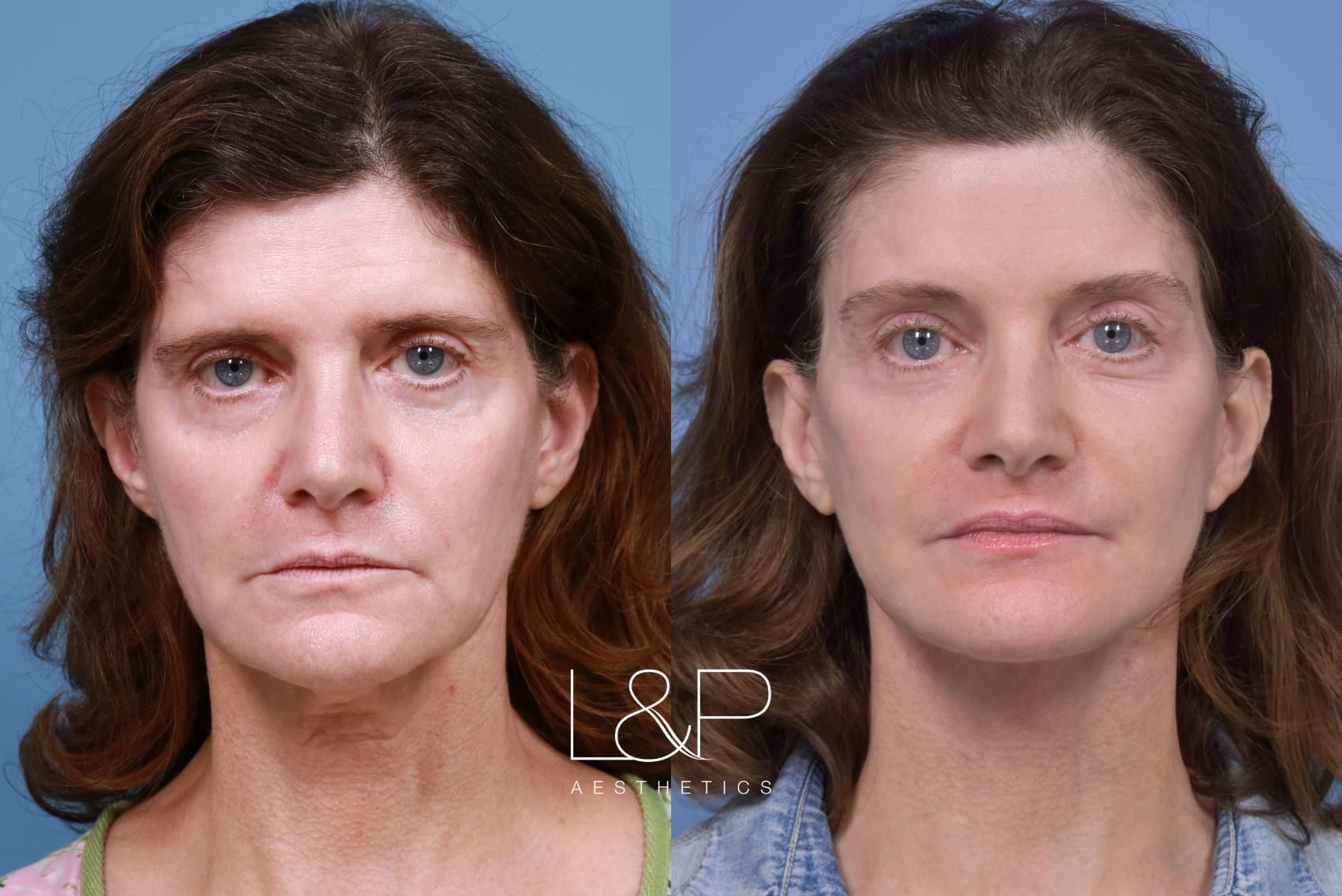 Facelift Neck Lift before and after treatment
