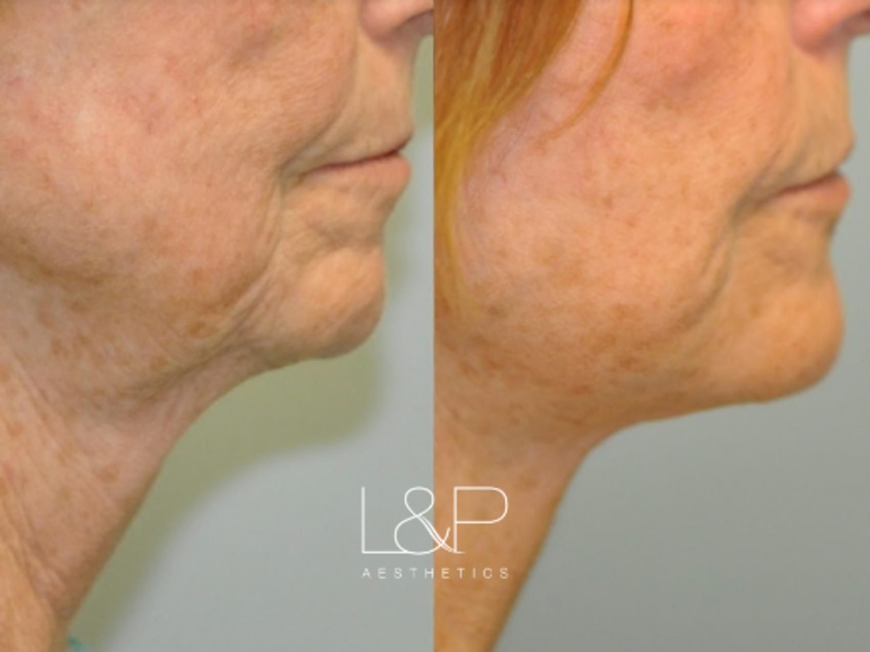 Facelift Neck Lift before and after treatment in Palo Alto, California
