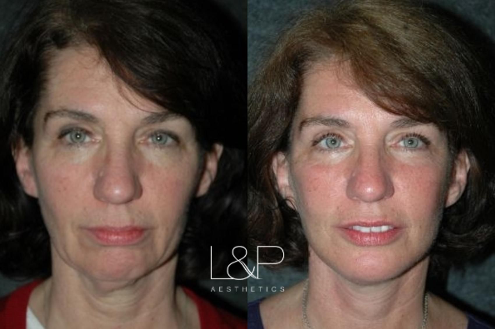 Facelift Neck Lift before and after treatment in the Bay Area