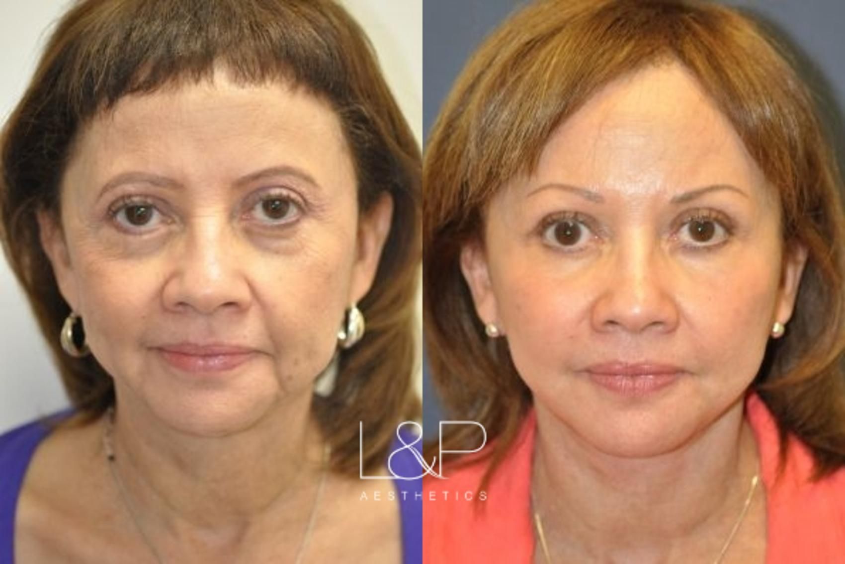 Facelift Neck Lift before and after treatment in Palo Alto, CA