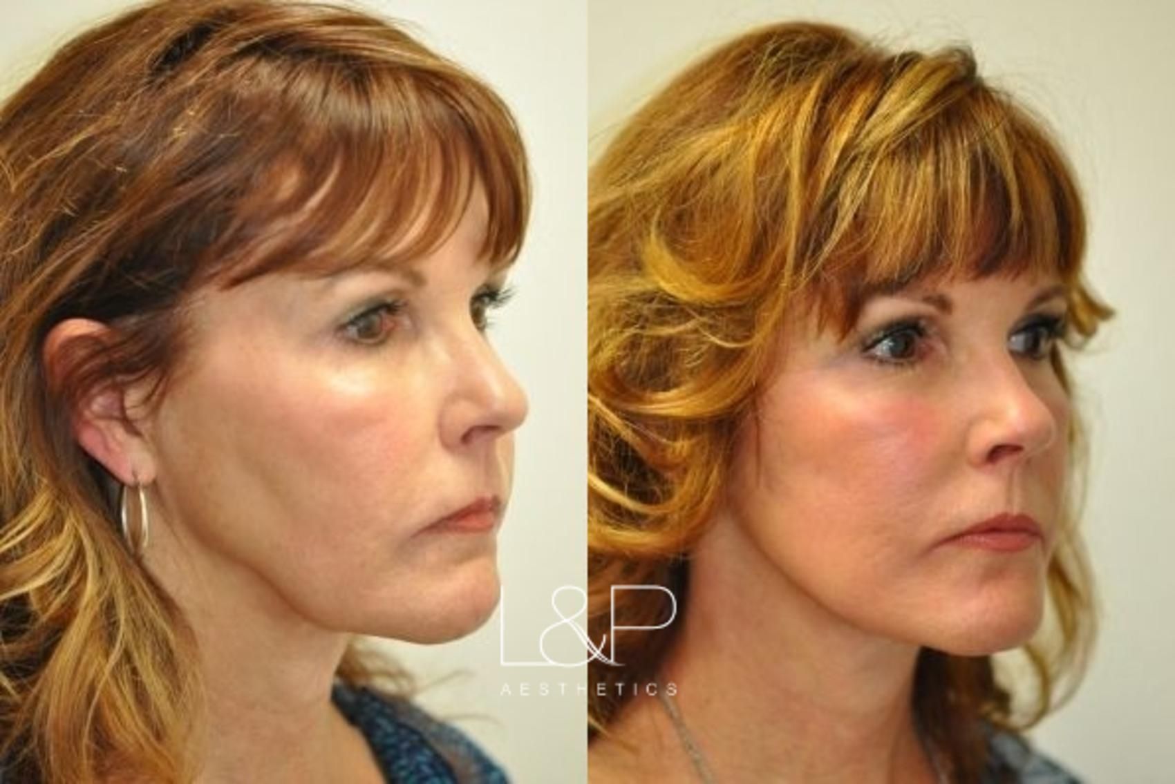 Facelift Neck Lift before and after treatment in Los Gatos, California