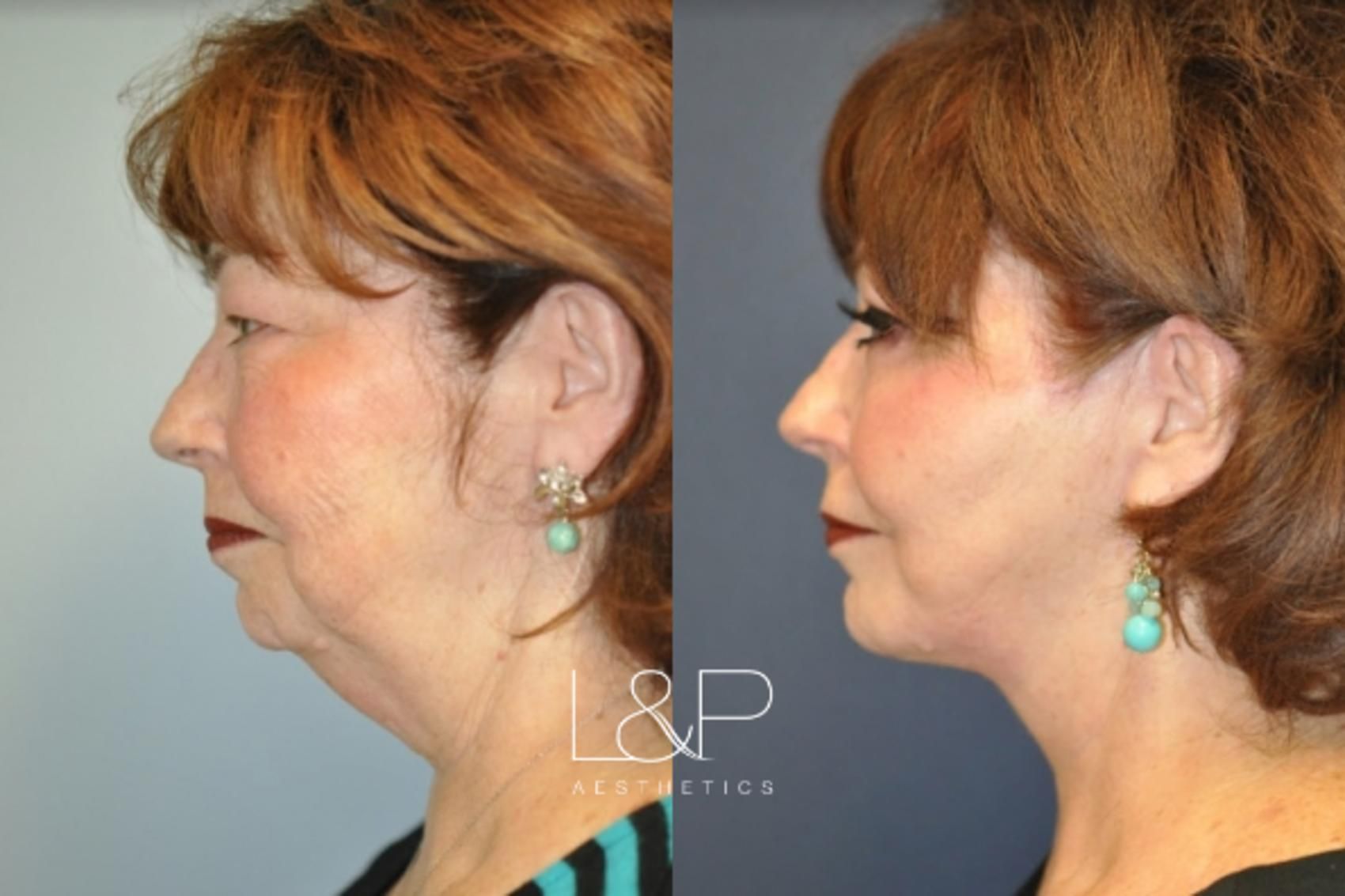 Facelift Neck Lift before and after treatment in Los Gatos, California