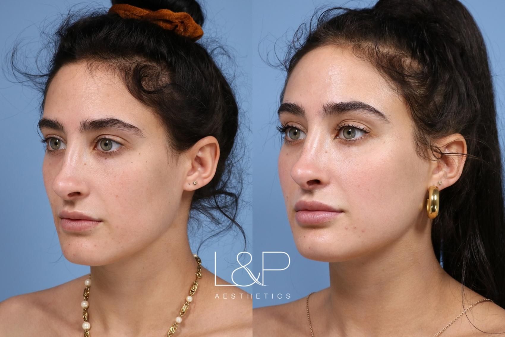 Facial Fillers before and after treatment