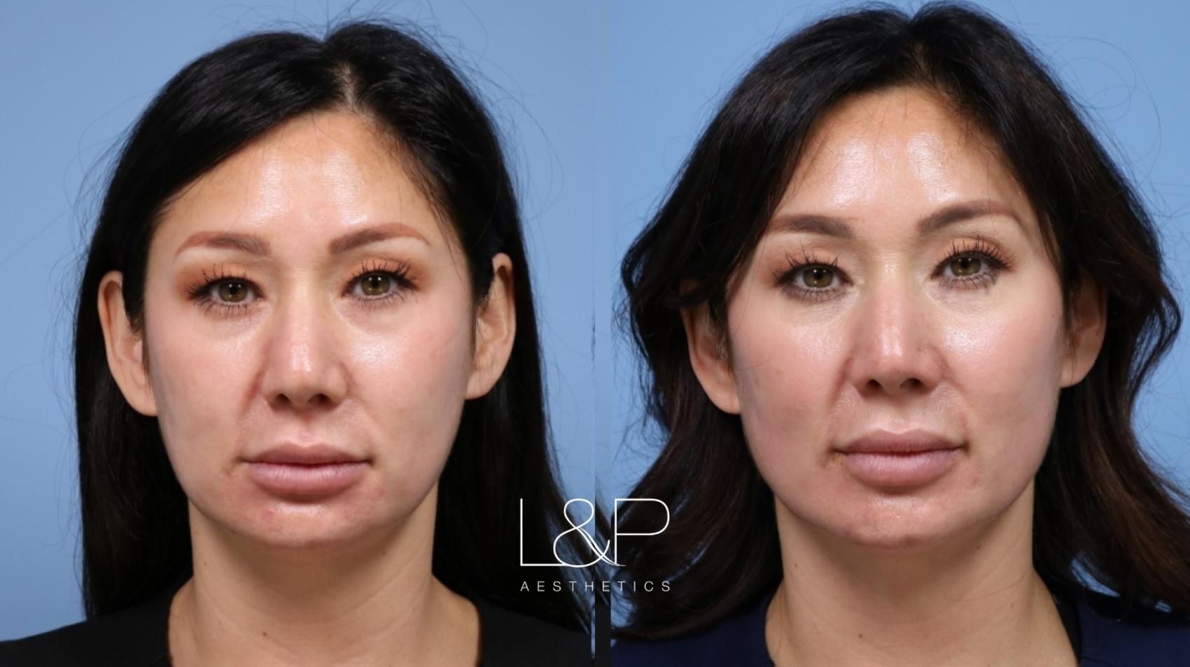 Facial Fillers before and after treatment