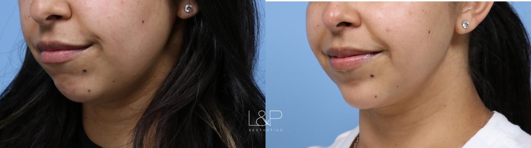Facial Fillers before and after treatment